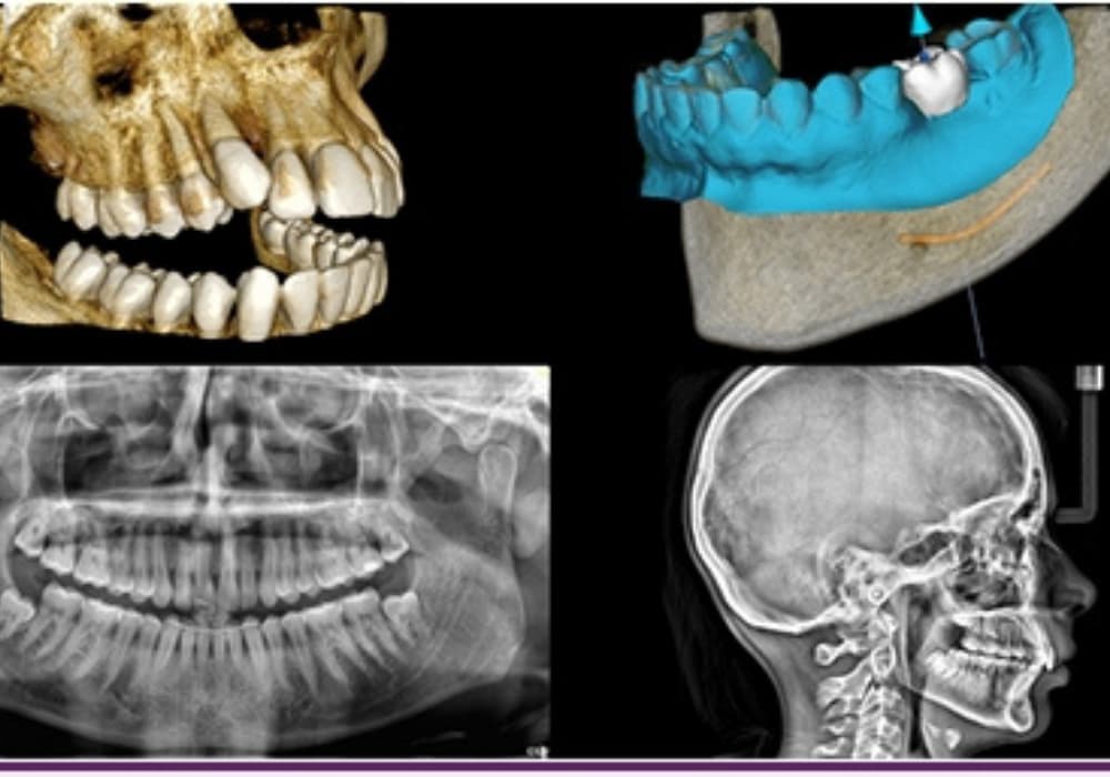 Fuentes dental, tu clínica en Lorca, incorpora la tecnología 3D en sus instalaciones. Se trata de un un equipo de tomografía computerizada de haz cónico.