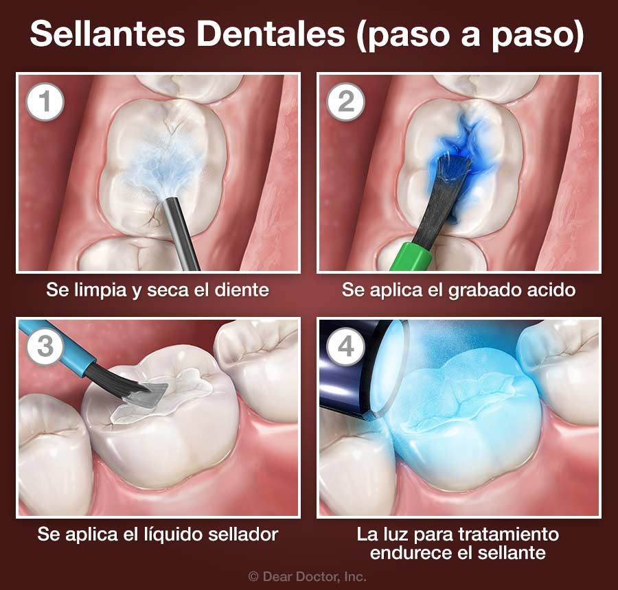 Infografía explicativa sobre el proceso del sellado de muelas en niños, con ilustraciones detalladas.